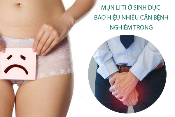 Mụn li ti ở sinh dục báo hiệu nhiều căn bệnh nghiêm trọng
