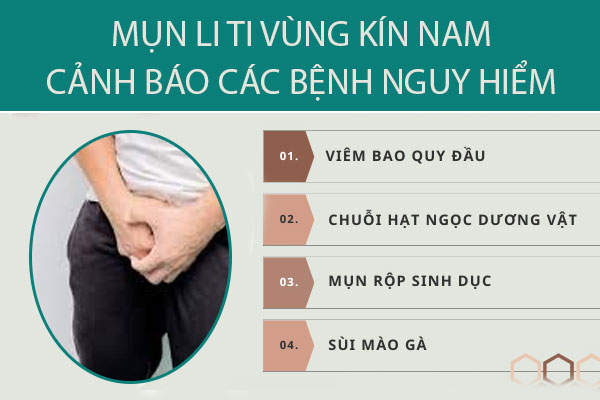 Mụn li ti vùng kín nam nguyên nhân do đâu, có nguy hiểm không?