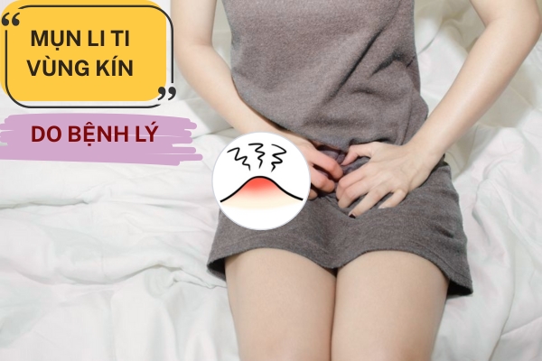 Giải đáp mụn li ti vùng kín nữ là bệnh gì và cách điều trị