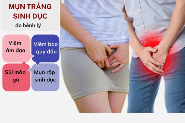 Mụn trắng sinh dục cảnh báo bệnh gì nguy hiểm không?